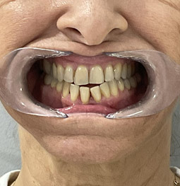 Carillas Zirconio antes