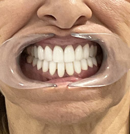 Carillas Zirconio después