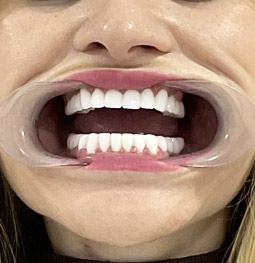 Coronas Zirconio después