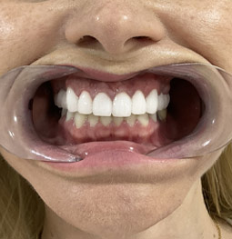 Coronas Zirconio después