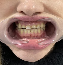 Coronas Zirconio antes