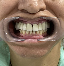 Rehabilitación con implantes antes