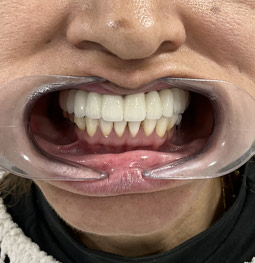 Rehabilitación con implantes después