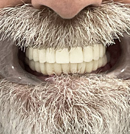 Rehabilitación con implantes después